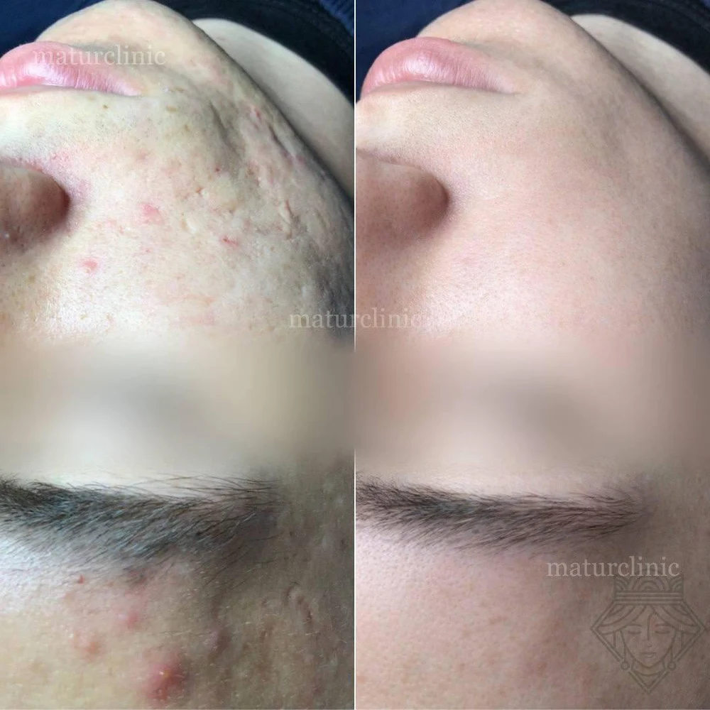 Косметологическая клиника, специализирующаяся на акне